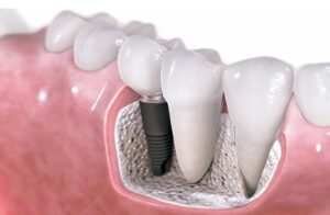 Alternative to Root Canals Treatment