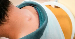 pilar cyst removal