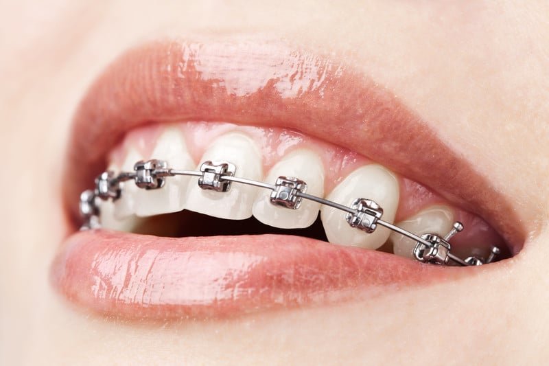 can you get braces if you don't need them