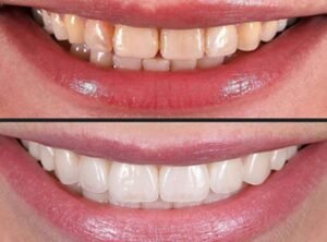 rubber bands braces before and after